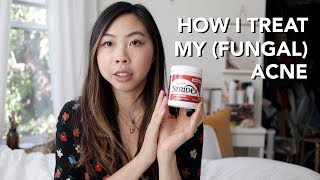 HOW I TREAT MY ACNE amp FUNGAL ACNE [upl. by Gilliam]