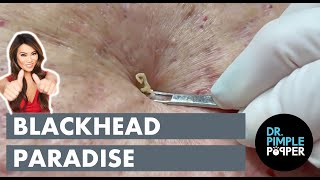 Blackhead Paradise [upl. by Jarietta]