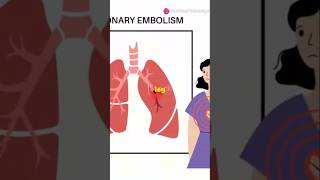 Pulmonary Embolism Explained What Every Med Student Needs to Know PulmonaryEmbolism medstudent [upl. by Reffotsirk961]