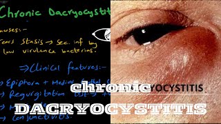 Chronic Dacryocystitis  lacrimal system [upl. by Silloh104]