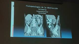 HIPERPLASIA PROSTÁTICA BENIGNA GENERALIDADES DIAGNOSTICO Y TRATAMIENTO [upl. by Eidda]