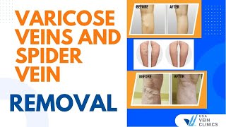 Varicose Veins and Spider Vein Removal  USA Vein Clinics [upl. by Spaulding348]