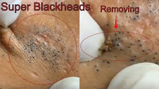 Super pimples amp Blackheads Extraction On face Acne Treatment Satisfying Cystic Acne [upl. by Merrie]