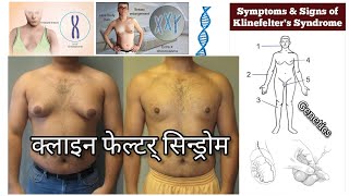 Klinefelter Syndrome  क्लाइनफेल्टर सिन्ड्रोम क्या है Klinefelter Syndrome causes symptoms in hindi [upl. by Matheson]