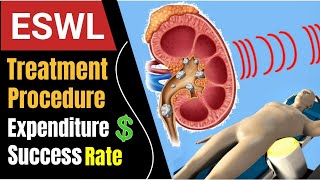 Extracorporeal Shock Wave Lithotripsy In Hindi  Lithotripsy Treatment For Kidney Stone In Hindi [upl. by Boniface]