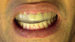 Bruxism Splint  Part 6  Insertion and Occlusion [upl. by Nahtnamas]