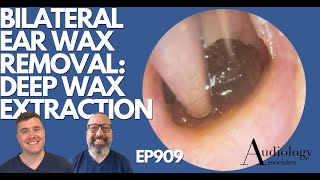 BILATERAL EAR WAX REMOVAL DEEP WAX EXTRACTION  EP909 [upl. by Zorina]