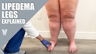 Lipedema Legs Explained  Dr Jaime Schwartz  Total Lipedema Care [upl. by Coltin598]