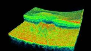 Topcon 3D OCT  Soft Drusen [upl. by Stromberg]