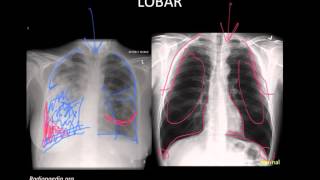 Pneumonia Imaging [upl. by Skyla725]