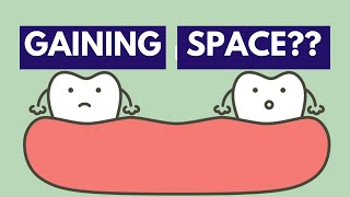 Methods for Space Gaining Orthodontics [upl. by Laubin]