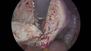 Laparoscopic Adenomyomectomy Using Osada Triple Flap Technique By Dr Ankita  Sankalp Hospital [upl. by Marcelline]