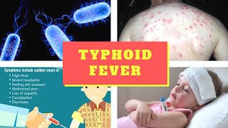 Typhoid Fever Symptoms – Causes Symptoms and Pictures of Enteric fever in Men women [upl. by Samara353]