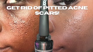 HOW TO GET RID OF PITTED ACNE SCARS [upl. by Aidyn78]