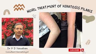 A novel treatment for Keratosis pilaris [upl. by Ez]