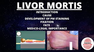 Livor mortis  Cause  Development  Fixation  Fate  Medicolegal importance  Forensic medicine [upl. by Wolcott]