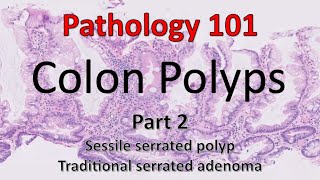 Colon Polyps  Part 2  Pathology 101 [upl. by Petronilla534]