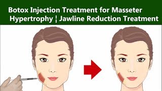 Botox injection for Wide Jawline Masseter Hypertrophy  The Esthetic Clinics India [upl. by Nezam]