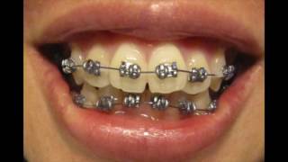 Quick Braces Progression [upl. by Thane]