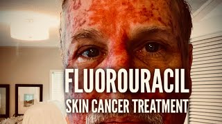 Fluorouracil Skin Treatment  Before During and After [upl. by Asp]