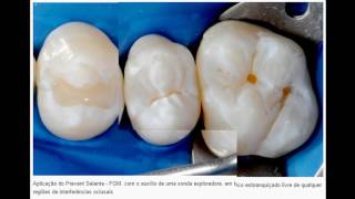 ODONTOPEDIATRIA Protocolo clínico para aplicação do selante de fóssulas e fissuras [upl. by Suzanna]