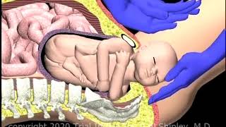 Shoulder Dystocia Suprapubic Pressure Animation by Cal Shipley MD [upl. by Persian]