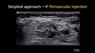 USguided Axillary Brachial Plexus Block  the Simple Guide [upl. by Halbeib]