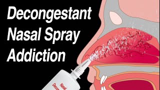 Decongestant Nasal Spray Addiction Afrin Zicam Sinex NeoSynephrine etc [upl. by Osmo]