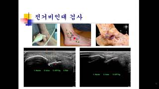 atf sonography [upl. by Neersan]