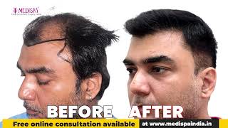 Dr Suneet Sonis 2 Year Hair Transplant Results Will SHOCK You [upl. by Mather]