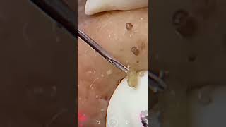 Skincare  Blackheads Removal 182 skincare skincare blackheads blackheads [upl. by Sorips]