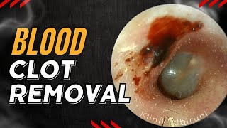 This Blood Clot Removal Cures His Tinnitus Instantly [upl. by Melvina]