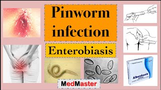 Enterobiasis Pinworm infection Symptoms Diagnosis amp Treatment [upl. by Kleinstein]