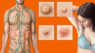 Swollen Lymph Nodes In The Armpit Causes And Home Care [upl. by Sidras250]