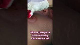 hijama therapy se kaise blood flow hota hai [upl. by Adey]