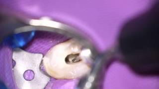 Ultraschall in der Endodontie [upl. by Annoed]