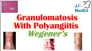 Granulomatosis with Polyangiitis Wegener’s granulomatosis  Symptoms Diagnosis Treatment [upl. by Atilahs]