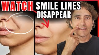 Nasolabial Folds DIY Hacks vs MedSpa Solutions [upl. by Ailaro]