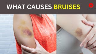 Bruises  Why does it happens  Symptoms Causes and treatment [upl. by Otreblig]