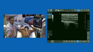 Erector Spine Plane ESP block  Live Demo [upl. by Aitrop647]