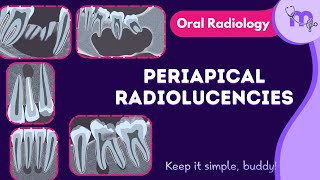 Periapical radiolucencies  Differential diagnosis  Radiographic features  Oral Radiology [upl. by Uokes]