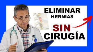 👨‍🔬Cómo TRATAR una Hernia Discal SIN CIRUGÍA [upl. by Jany]