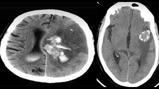 CNSSpotters 16 case Radiology neuroradiology radiological radiopedia frcr medicalimaging [upl. by Nnyltiac]