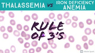 Thalassemia vs Iron Deficiency Anemia Rule of 3s Peripheral Blood Smear Hematology Hemepath Basics [upl. by Eeloj889]