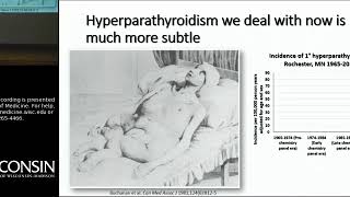 9718 Hyperparathyroidism Beyond Stones and Bones [upl. by Bultman]