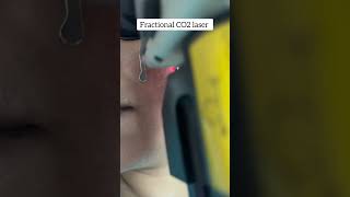 Fractional co2 laser with Erbium glass for acne scar co2laser bestskinclinic skincare [upl. by Ajup]