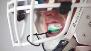 ULTRA 2STC MOUTHGUARD [upl. by Sollars]