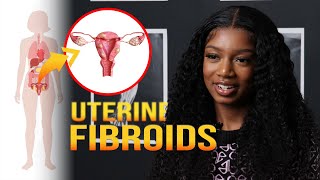 Uterine Fibroids Complications  MarieCatherine Kodjo [upl. by Pryce128]