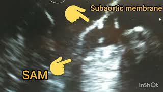 Double LVOT obstruction SAMsubaortic membrane [upl. by Wescott]