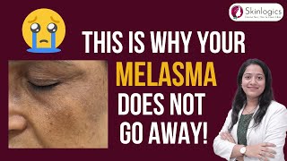 Melasma Mistakes to Avoid  Best Melasma Treatment in Noida  Skin Lightening Treatment in Noida [upl. by Ttenyl]